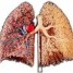 deuxieme-cause-du-cancer-du-poumon